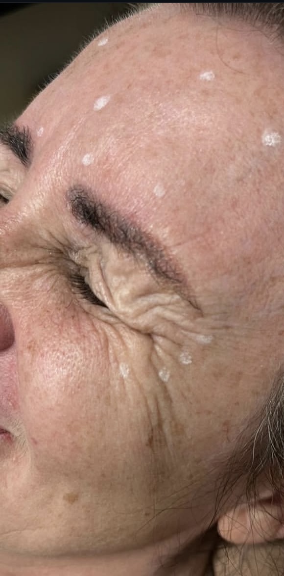 Before anti-wrinkle injection treatment